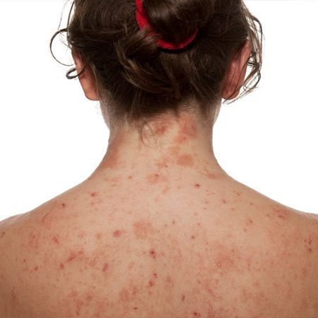 อาการเอดส์